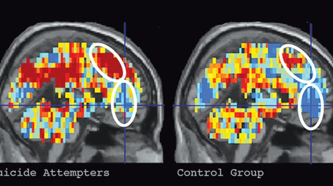 A new study from Pitt and CMU finds that suicidal thoughts may be identifiable using fMRI